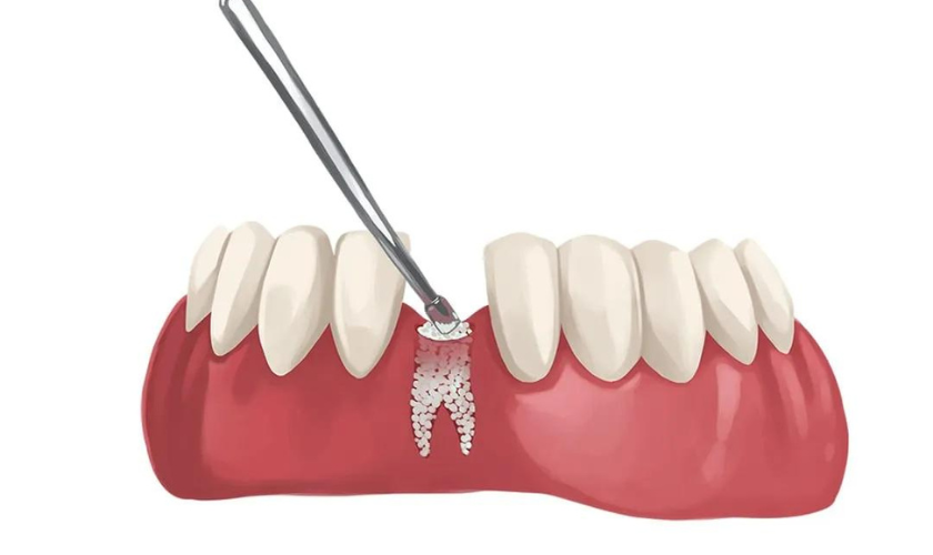 Why Bone Grafting Is Essential for Dental Implants